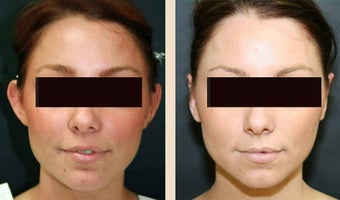 Otoplasty before 634260
