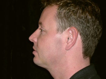 Necklift after 236061