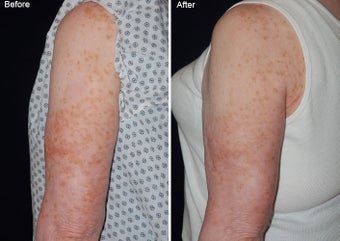 Fraxel laser resurfacing before 97766