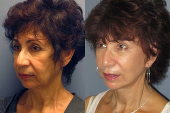 Lite Lift, Brow Lift before 523348