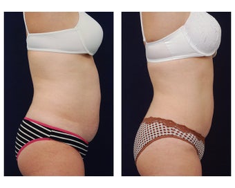 Liposuction 391783