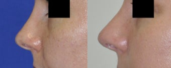 Revision Rhinoplasty before 548883