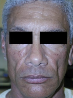Silicone Microdroplet Therapy for Facial Atrophy before 334062