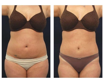 Liposuction before 397041