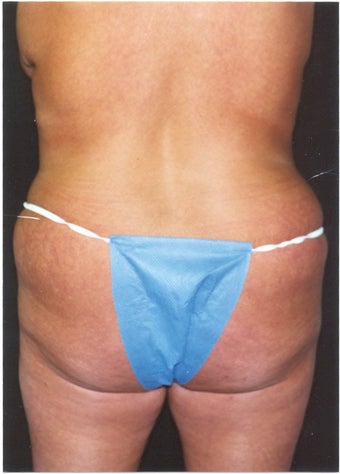 Body Lift 379788