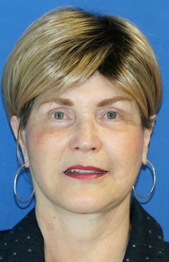 1 month post op: Facelift, Necklift, Browlift, Fat Transfer, Upper Bleph after 456304
