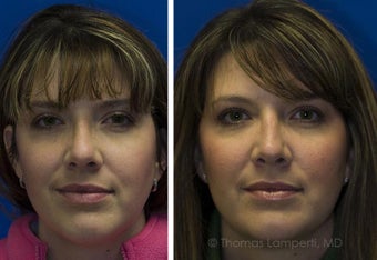 Revision Rhinoplasty before 234401
