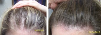 Female medical treatment for hair loss (no surgery) before 369188
