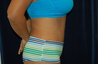 Abdominoplasty 361995