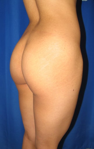 Buttocks Augmentation 420084