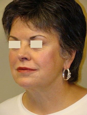 Juvederm Injections for midface after 103876