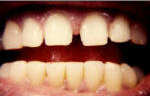 Porcelain Veneers before 535256