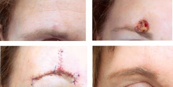 MOHS Skin Cancer Surgery before 369213