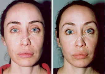 Non-Surgical Face Lift- Exoderm before 242983