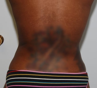 Smart Lipo after 125008