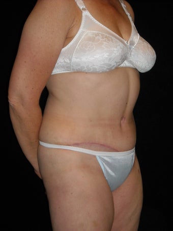 Abdominoplasty 420080