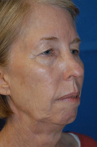 Face Lift before 322007