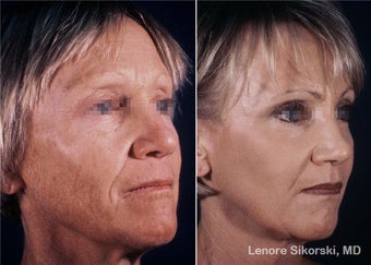 Full Face Laser Resurfacing and Upper Bleph before 106304