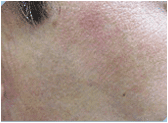 Photofacial/IPL after 267551