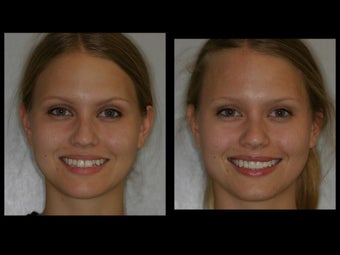 Smile Makeover with Veneers and Teeth Whitening before 58883