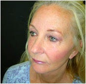 Facelift, Endoscopic Forehead Lift, Quadrilateral Blepharoplasty after 205368