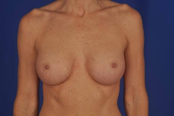 50 year-old woman desired breast implants after 634069