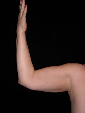 Liposuction of upper arm after 237752