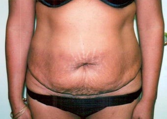 Abdominoplasty before 238220