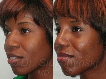 African American Rhinoplasty after 374006