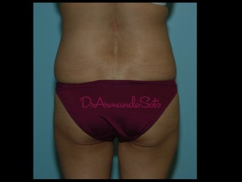 Brazilian Butt Lift before 157535