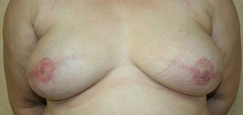 Breast Reconstruction after 526415