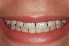 Porcelain Veneers before 379804