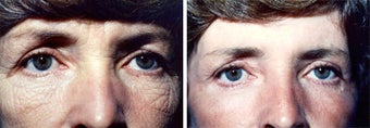 Chemical Peel before 652150