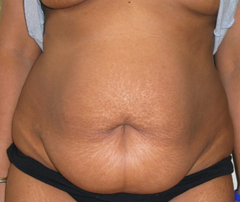 Abdominoplasty before 458934