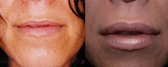 Lip Augmentation before 192157
