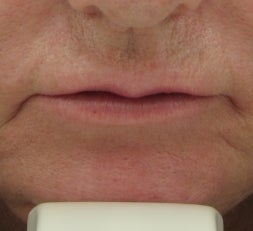 63 year old lip Augmentation with Juvederm before 53008