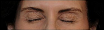 Botox after 66929