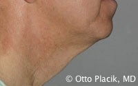 Cervicoplasty before 567302