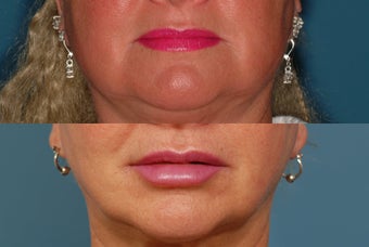 Restylane to Lips before 409155