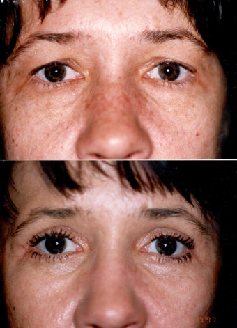 Blepharoplasty and Full Face CO2 Laser Resurfacing before 337080
