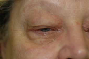 Bilateral upper and lower eyelid surgery 341554
