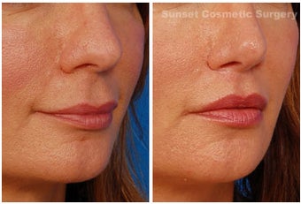 Lip lift 355955
