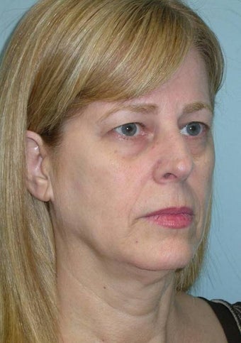 Full Facial Rejuvenation and Rhinoplasty before 182370