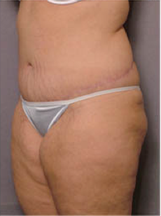 Adominoplasty 428195