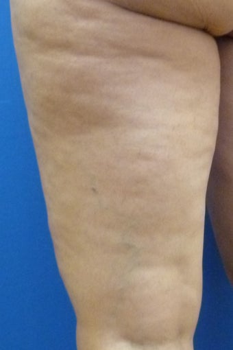 Cellulaze 571586