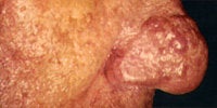 Severe Acne Rosacea before 272034
