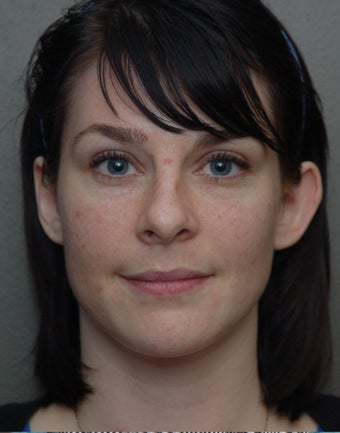 Otoplasty before 273258
