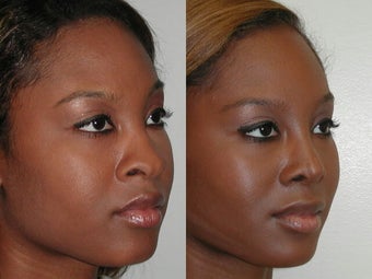 African American Rhinoplasty after 210166