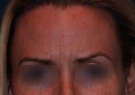 Botox before 555513