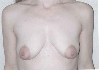 Breast lift with augmentation before 633947